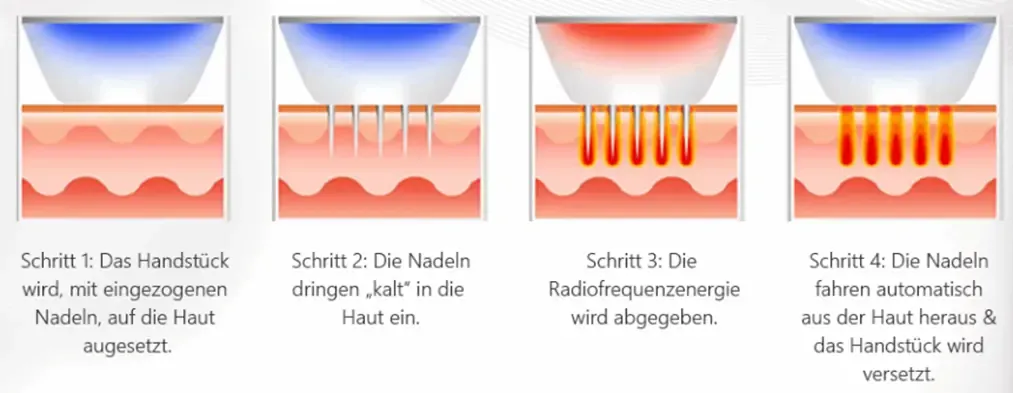 Microneedling Schaubild - Nadeln dringen in die Haut und geben Radiofrequenzenergie ab