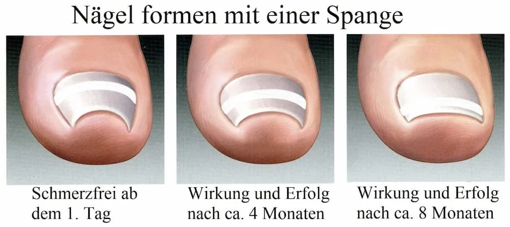 Spange für Nagelkorrektur